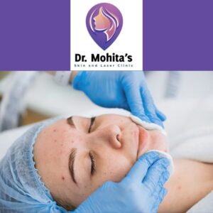 Anti-Acne Treatment in Kanpur
