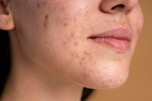 Best Anti-Acne Treatment in Kanpur