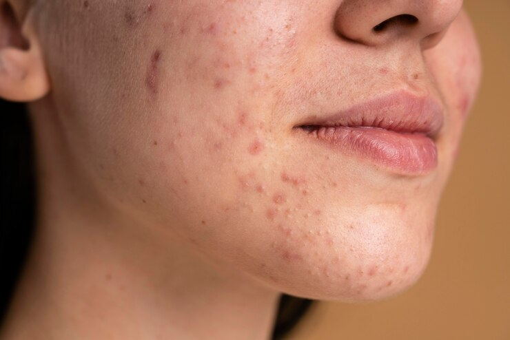 Best Anti-Acne Treatment in Kanpur