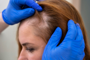 Best PRP Hair Loss Treatment in Kanpur