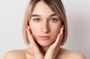 Best Acne Treatment in Kanpur